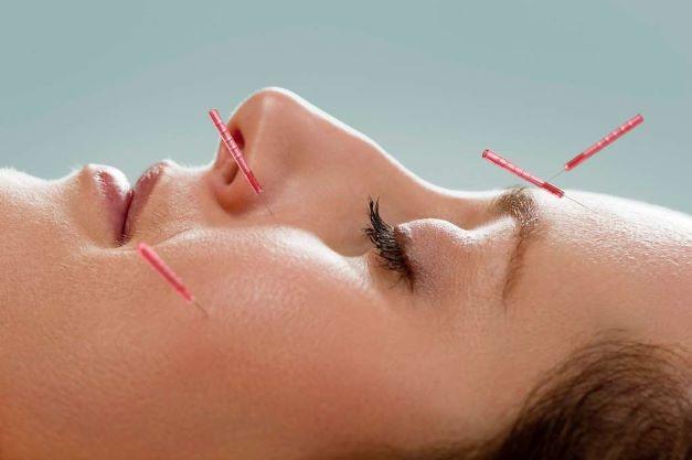 Acupuncture Needles Supplier in Ireland main image of woman getting acupuncture