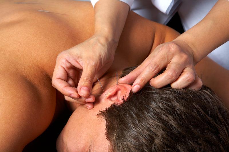 Auricular Acupuncture Products and Needles